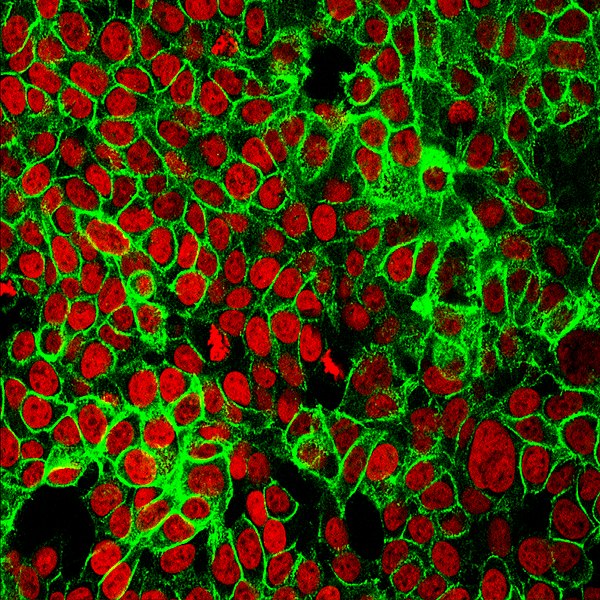 Nuevos nanofármacos magnéticos permiten atacar con precisión las células de cáncer de colon